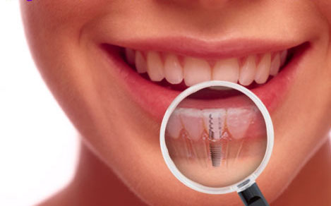tooth implant bridge